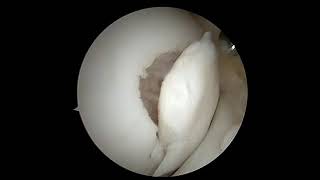 Arthroscopic Fixation of Osteochondritis Dissecans of the Knee [upl. by Atenik]