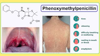 phenoxymethylpenicillin [upl. by Hayley]