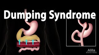 Dumping Syndrome Animation [upl. by Ayocat]