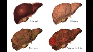 Vivre avec une cirrhose crédit  Cirrhosis Care Alberta [upl. by Eelarak]