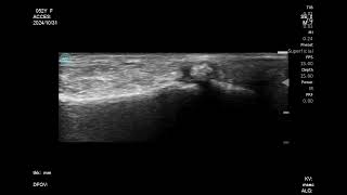 53F foot pain Sesamoiditis ApacheUltrasound [upl. by Nylacaj675]