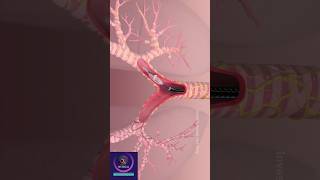 Lung Denervation Procedure  COPD Disease Treatment lungdisease [upl. by Ytnom]