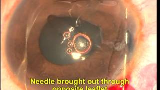 Siepser knot iridoplasty in phakic eye Soosan Jacob 22 min [upl. by Feeney]