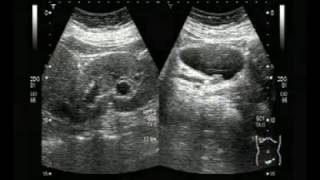 Ultrasound Video showing tracing of a very small stone in Ureter [upl. by Luanni]