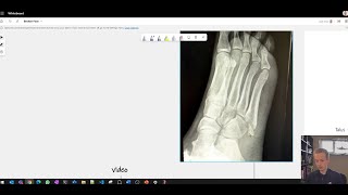 My experience with fifth metatarsal fracture  recovery timeline UK NHS what you should expect [upl. by Ilarin237]