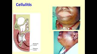 Bacterial Infections of oral and maxillofacial region An Overview [upl. by Suu]