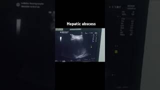 Hepatic abscess on ultrasound [upl. by Ubald223]