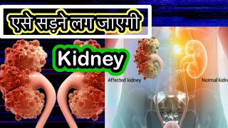 Renal Cyst Causes Signs and Symptoms Diagnosis and Treatment kidneycyst renalcyst [upl. by Lucretia]