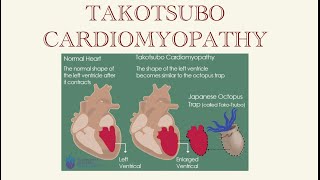 Takotsubo Cardiomyopathy  Quick Review [upl. by Yattirb]