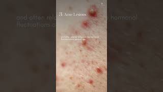 Oily Skin vs Acne Prone Skin Whats the Difference  Ensoul Medical Clinic [upl. by Kola]