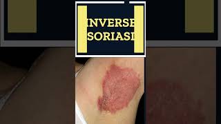 5 Types of Psoriasis You Do Not Know  Shorts [upl. by Ingeberg]