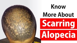 Cicatricial Alopecia Or Scarring Alopecia Natural Treatment At Dr Rohits Alopecia Treatment Center [upl. by Betthezul]