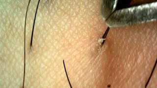 Removing Ingrown Hair with Tweezers Mastering Pro Techniques [upl. by Eidarb93]