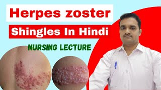 herpes zoster skin disease  shingles  symptoms treatmentcare  herpes skin disease [upl. by Holloway470]