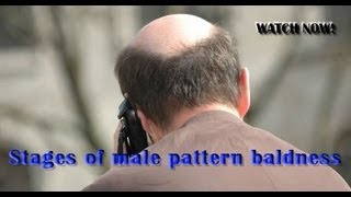 Stages of male pattern baldness [upl. by Anec396]