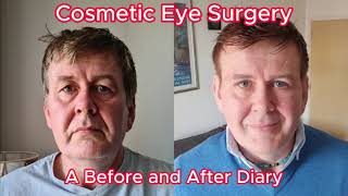 Cosmetic Eye Surgery  Before and After Diary  Blepharoplasty Direct Brow Lift and Mid Face Lift [upl. by Walford]