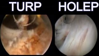 TURP Vs HoLEP [upl. by Om135]