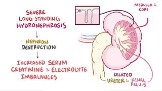 Hydronephrosis  Renal Pathology  Osmosis [upl. by Ahsaz514]