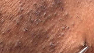 INGROWN HAIR REMOVAL 88  HAPPY NEW YEARS 2024 ❤️ [upl. by Lleruj499]