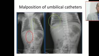 Case 13 malposition of umbilical catheter UVC [upl. by Emile848]