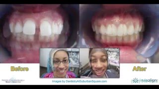 Invisalign Before amp After Slideshow [upl. by Bond]