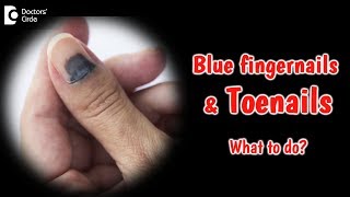 Bluish discoloration of nails What does it mean Dr Rajdeep Mysore [upl. by Nerdna]