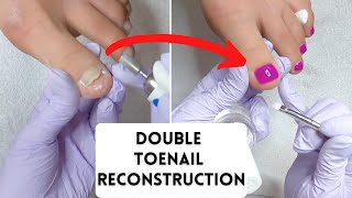 Double Toenail Reconstruction With LCN Barefoot Gel And Gehwol Nail Repair Gel [upl. by Klaus19]