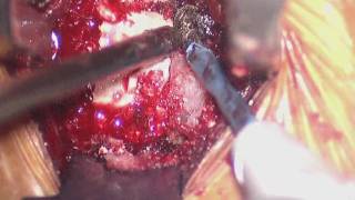 Part 4 of 4 C6C7 ACDF Cervical Spinal Fusion with Allograft [upl. by Eanram869]