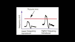 Aliasing Ultrasound Physics [upl. by Hurst]