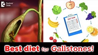 Food and drinks to eat and avoid if you have Gallstones  Dr Nanda Rajaneesh  Doctors Circle [upl. by Goodard]