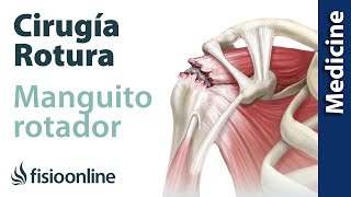 Lesión del manguito rotador  Qué es diagnóstico y tratamiento indicado en fisioterapia y cirugía [upl. by Ayotahs]