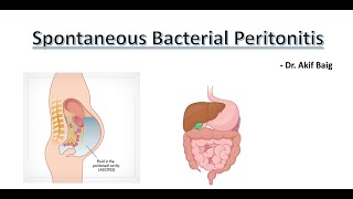 Spontaneous Bacterial Peritonitis  Dr Akif Baig [upl. by Whitelaw410]