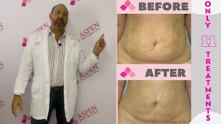 Liposuction Fibrosis Treatment Soften and Smooth Lumps and Bumps [upl. by Robbert]