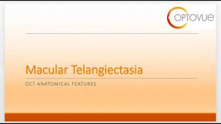 Macular Telangiectasia [upl. by Ailet]