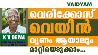 വെരിക്കോസ് വെയിൻ വൃണം ആയാലും മാറ്റിയെടുക്കാം NaturalAyurvedic Treatment Varicose Veins kvdayal [upl. by Lynnell51]