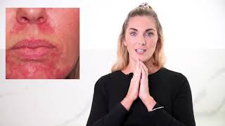 How To Treat Skin Redness  Rosacea  its Causes and Treatments [upl. by Prussian]