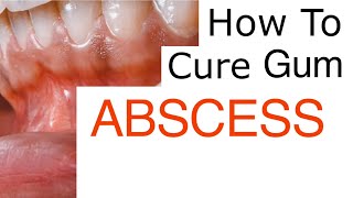 Gum Abscess Explained [upl. by Moia]