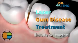 Laser Periodontal Therapy  Ask Dr Ting [upl. by Matt683]