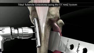 Tibial Tubercle Osteotomy using the T3 AMZ System [upl. by Eneiluj858]