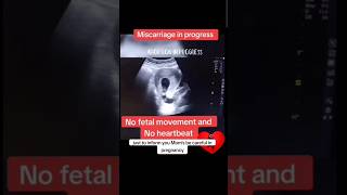 Miscarriage process no fetal movements amp heartbeat viralvideo trending baby [upl. by Horst]