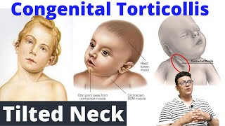 Tilted Neck  Congenital Torticollis  Congenital Disorder [upl. by Ynahpets447]