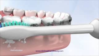 How to use your Philips Sonicare Toothbrush perfect for braces too [upl. by Ettenuahs773]