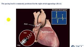 Part 7 types of pacemakers الجزء السابع انواع المنظمات الكهربائية للقلب [upl. by Arette763]