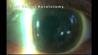 Radial keratotomy RK [upl. by Leary]