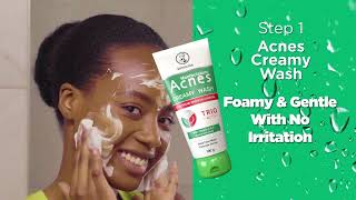 ACNES KENYA  Quickly Clears Pimples [upl. by Hanavas]