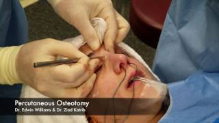 Percutaneous Osteotomy amp Breaking the Nose During Rhinoplasty Surgery [upl. by Hsirehc]