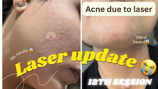 12th LaSER HAIR REMOVAL UPDATE NO RESULTS 😭 GUNJANVLOGS laserhairremoval [upl. by Freed151]