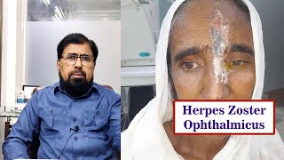 Herpes zoster treatment symptoms and guidelines in UrduHindi [upl. by Ynohtnaeoj]