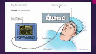 Bispectral index in hypercapnic encephalopathy  Video abstract ID 167020 [upl. by Richie]