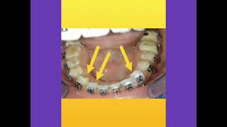 ortho jóurney of class1 type 1 openbite 2022 2024 sept beforeafterresult orthodontic [upl. by Am]